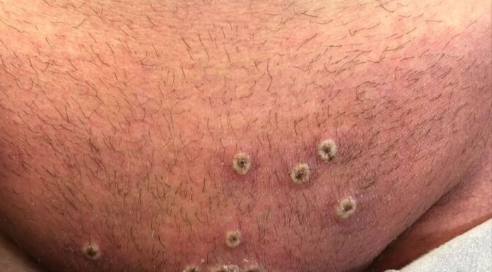 Viruela del mono: Estas personas podrán vacunarse contra el virus