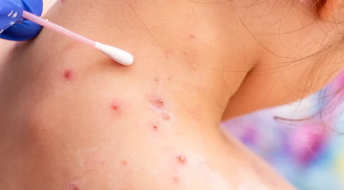 Atención Hidalgo: Detectan posible caso de viruela del mono