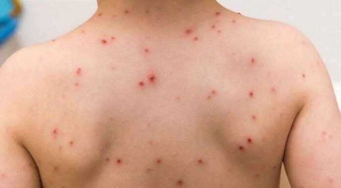 Viruela símica en Hidalgo, estas son las medidas preventivas