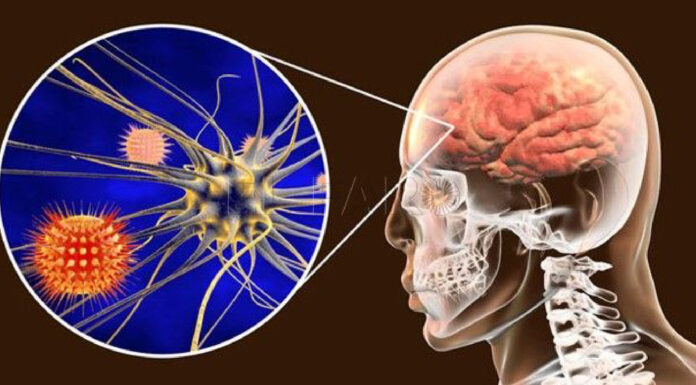 Durango: Aumentan muertes por meningitis aséptica