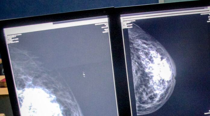 En lo que va del año se han diagnosticado 42 nuevos casos de cáncer de mama en Hidalgo