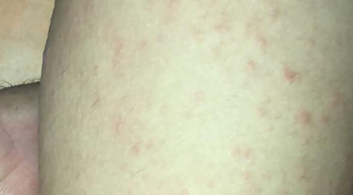 ¿Cómo se manifiesta y qué hacer frente al Coxsackie?